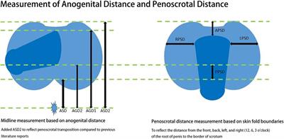 Development and verification of machine learning model based on anogenital distance, penoscrotal distance, and 2D:4D finger ratio before puberty to predict hypospadias classification